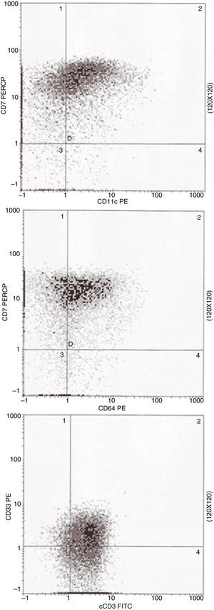 Flow cytometric analysis of bone marrow sample at diagnosis. Blasts show co-expression of CD11c and CD64 antigens together with CD7 and are also positive for cCD3 and CD33 antigens.