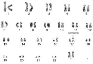 G-banding chromosome analysis showing isolated del(17)(p11.2). Thus, based on the 2008 revision of the WHO classification of myeloid neoplasms and acute leukemia,5 a diagnosis of MPAL, T-cell/myeloid with a monocytic component was made.