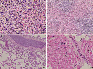 Profound leukemic blast infiltration was found in many organs, including the spleen (A), liver (B), lung (C), and heart (D) (hematoxylin–eosin stain).