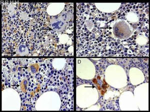 Photomicrograph of latent transforming growth factor-beta 1 immunoexpression (400×) in the controls and patients (essential thrombocythemia and primary myelofibrosis) according to the intensity of the reaction: (A) negative (0), (B) weak (1), (C) moderate (2), and (D) strong (3) (arrow).