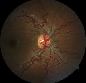 Tortuous vessels in an 11-year-old female with hemoglobin SS.