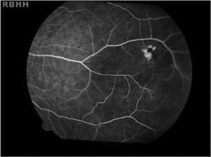 Black sunburst. Hyperpigmented lesions observed in the retinal periphery of an 18-year-old female with hemoglobin SC.