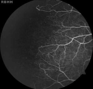 Peripheral arteriolar occlusions and arteriovenous anastomoses in a 14-year-old male with hemoglobin SC.