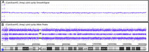 Affymetrix® Chromosome Analysis Suite image showing normal chromosome 4. (A) Smooth signal representing a normal copy number (purple line CN: 2.00). The information on copy number variations is from non-polymorphic probes. (B) Allele peaks representing a normal genotype with AA, AB and BB alleles (three purple lines). Information on the genotype is from polymorphic probes.