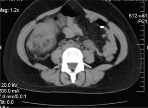 Soft tissue mass in the upper third of the abdomen with air-fluid level, dilation of the anterior intestinal loops and partial obstruction.