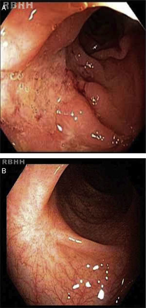 (A) Serpiginous ulcerations, with fold convergence, intervening ridges of swollen congested mucosa and central fibrinous exudate. (B) White scaring and scar retraction seven months after autologous hematopoietic stem cell transplantation.