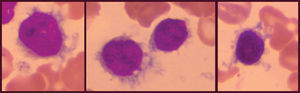 Small/intermediate-sized cells with moderate pale-gray cytoplasm, round/oval nuclei with smooth nuclear borders, stippled chromatin, occasional nucleoli, cells have circumferential hair-like and short, blunt cytoplasmic projections.