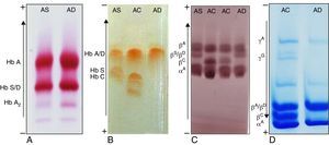 Electrophoretic mobility of Hb D-Punjab compared to other known hemoglobins, such as Hb A, S and C. Images correspond to hemoglobin electrophoresis in cellulose acetate (A), hemoglobin electrophoresis in agarose gel (B), polypeptide chains electrophoresis in cellulose acetate (C) and polypeptide chains electrophoresis in polyacrylamide gel (D). The genotypes of each sample are at the top of the figure. Current direction and position of the different hemoglobins are beside each method.