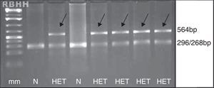 Agarose gel visualization of fragments generated by the PCR-RFLP technique for screening of β121 Glu→Gln (GAA→CAA) mutation. Normal alleles generate two fragments and mutant alleles maintain the 564bp fragment, indicated by the arrows. N: absent mutation; HET: heterozygous for Hb D-Los Angeles; mm: molecular marker of 100bp. Restriction enzyme: EcoRI (G↓AATTC).