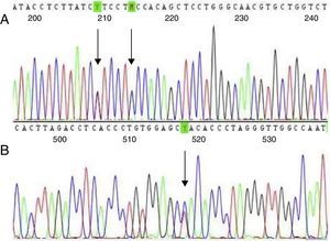 Sequencing four-color chromatogram showing (A) IVS-II-844 (C>A) and IVS-II-839 (T>C) mutations in cis; and (B) the −92 (C>T) mutation.