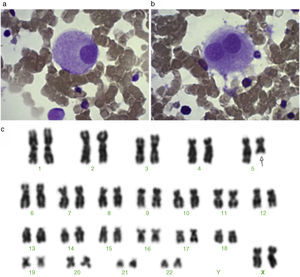 (a) Megakaryocyte with a non-lobulated nucleus. (b) A ‘dumbbell-type’ megakaryocyte. (c) Karyotype showing a large terminal deletion of chromosome 5 – 46,XX,del(5)(q22).