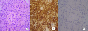 Histologic features. (A) Poorly differentiated carcinoma (hematoxylin and eosin: magnification 400×). (B) Strong diffuse reactivity for CD20 (magnification 400×). (C) Negativity for pan keratin (magnification 400×).