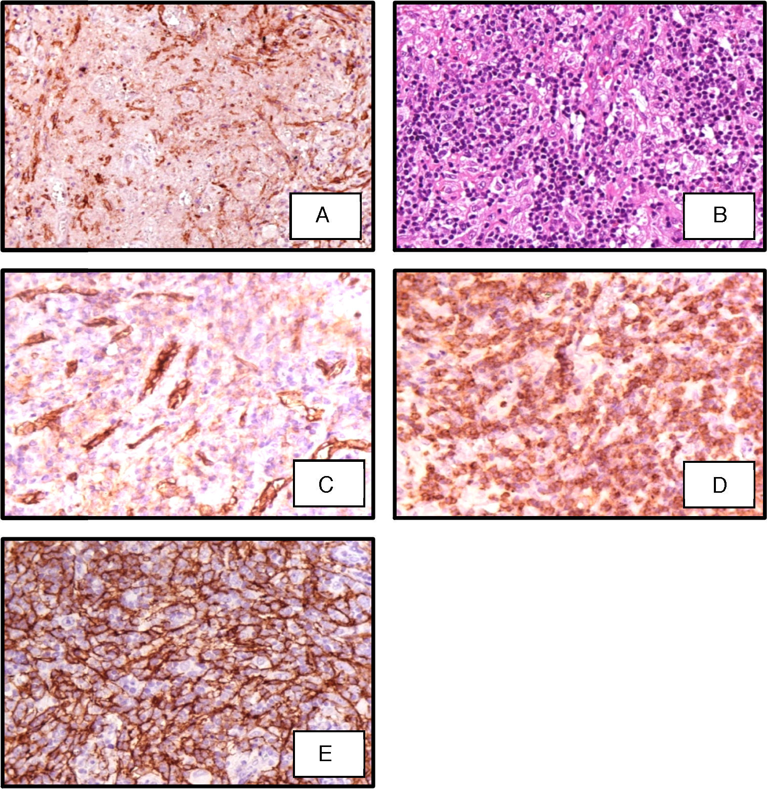 A difficult case of angioimmunoblastic T-cell lymphoma to diagnose ...