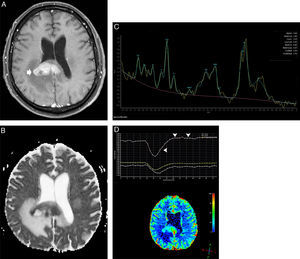 Diffuse large B-cell lymphoma in the corpus callosum. An axial T1 image after intravenous gadolinium administration (A) shows a homogeneous enhanced mass in the splenium of the corpus callosum, which is predominantly in the right hemisphere (arrow). An axial apparent diffusion coefficient map (B) confirmed a very low signal intensity in the solid lesion. Note the hyperintensity of the perilesional vasogenic edema. Proton magnetic resonance spectroscopy (C) shows decreased N-acetylaspartate levels and high choline/N-acetylaspartate and choline/creatinine ratios. Note the increased lipid and lactate peaks (0.9–1.3ppm). A magnetic resonance perfusion sequence (dynamic susceptibility contrast magnetic resonance image T2*) (D) confirmed the absence of neoangiogenesis (low relative cerebral blood volume). Note the high percentage of signal intensity recovery (the ascending part of the curve above the baseline as indicated by the vertical arrowheads).