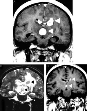 Corticotherapy effects in a primary central nervous system lymphoma. An axial T1 image after intravenous gadolinium administration (A) shows multifocal primary central nervous system lymphoma as deep homogeneous enhanced masses in the corpus callosum, which are adjacent to the third ventricle (arrowheads). A comparative T2-weighted image (B) depicts nodular hypointensity in the lesions with perilesional vasogenic edema (arrowheads). A comparative T1 image after intravenous gadolinium administration (C) was obtained after corticotherapy and demonstrated evident tumor shrinkage (‘vanishing tumors’).
