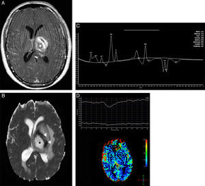 A focal brain lesion in an AIDS patient (toxoplasmosis versus lymphoma). An axial T1 image after intravenous gadolinium administration (A) shows a large periventricular lesion in the left thalamus with extensive necrosis (asterisk) and thick peripheral enhancement. An axial apparent diffusion coefficient map (B) confirmed a very low signal intensity in the solid portion of the lesion (arrowheads) compared with the central area of necrosis (asterisk). Additionally, note the hyperintensity of the perilesional vasogenic edema. Proton magnetic resonance spectroscopy (C) confirmed the presence of elevated lipid and lactate (0.9–1.3ppm) and choline levels with reduced N-acetylaspartate levels. A magnetic resonance perfusion sequence (dynamic susceptibility contrast magnetic resonance image T2*) (D) confirmed the absence of neoangiogenesis (low relative cerebral blood volume). These features supported the diagnosis of lymphoma.