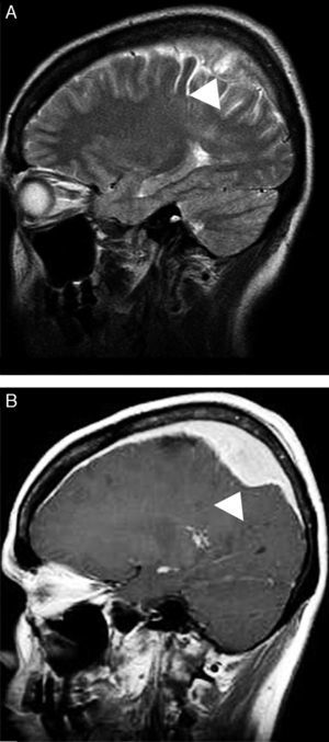 Mucosa-associated lymphoid tissue (MALT) lymphoma mimicking meningioma. A sagittal T2-weighted image (A) shows a solid extra-axial lesion that infiltrated the dura mater in the parietal region (arrowheads). A comparative image on a T1-weighted sequence after intravenous gadolinium administration (B) confirmed homogeneous contrast enhancement that was associated with an extensive dura tail, which mimicked the appearance of a meningioma (arrowhead).