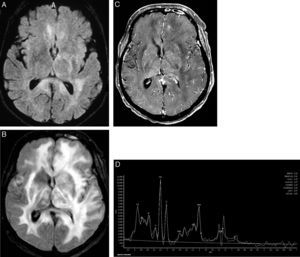 Lymphomatosis cerebri in an immunocompetent patient. An axial fluid-attenuated inversion recovery image (A) shows unspecific diffuse hyperintense areas on both brain hemispheres that cross the splenium of the corpus callosum with no mass effect. No contrast enhancement was observed (not shown). A comparative fluid-attenuated inversion recovery image (B) was obtained after two months without specific therapy confirming the extensive progression of the disease, and exhibiting confluent hyperintensity of both brain hemispheres, predominantly of the left. Minimal mass effect and no gadolinium-enhanced areas were observed. A proton magnetic resonance spectroscopy study (C) was useful to support a presumptive diagnosis and demonstrated increased choline levels and an increased choline/N-acetylaspartate ratio (>1.9), which were associated with reduced N-acetylaspartate levels and elevated lactate peaks.