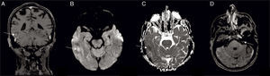 (A) Coronal T1-weighted magnetic resonance imaging after gadolinium administration showing right temporal leptomeningeal, parenchymal (arrow) and pachymeningeal enhancement; (B) diffusion weighted image with hyperintensity and (C) apparent diffusion coefficient map with hypointensity (arrow), confirming restricted diffusion; (D) axial T1-weighted magnetic resonance imaging after gadolinium administration, showing abnormal enhancement in the left facial nerve (arrow).