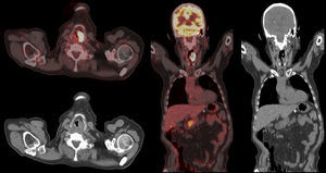 Initial staging using fluorine-18 fluorodeoxyglucose positron emission tomography-computed tomography (18F-FDG-PET/CT) revealed a hypermetabolic lesion with high rate of cell proliferation that extended from the base of the tongue to the left vocal cord, resulting in transmural thickening and slight displacement of the midline (axial and coronal views) with SUVmax: 37.3 (SUV mediastinum: 2.8). An additional hypermetabolic focus left of the transverse processes of D3 and two abdominal para-aortic lymphadenopathies were also observed.