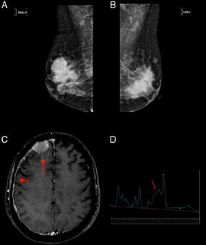 (A and B) Mammography: hyperdense and lobulated nodules with circumscribed margins; (C) extra-axial expansive lesion compatible with plasmocytoma in the right frontal convexity (arrow) with pachymeningeal impregnation (arrowhead), demonstrating central nervous system involvement; (D) spectroscopy of the same patient showing an increased glutamine–glutamate complex (arrow) resulting from elevated central nervous system ammonia.