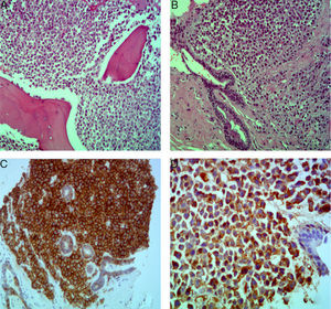 (A) Breast and (B) bone marrow biopsies, both with hematoxylin and eosin (HE) staining characterized by infiltration of plasma cells; Breast biopsy immunochemistry with (C) lambda restriction and (D) CD138+ immunoexpression.