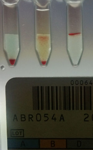 Results of forward blood grouping by column agglutination technology showing mixed field agglutination with anti-B.