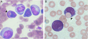 Morphology of AML-M4 with hemophagocytosis by blast cells. Bone marrow aspiration stained by May–Grunwald–Giemsa shows myeloblast and monoblast cells with phagocytosis of red cells and lymphocytes.