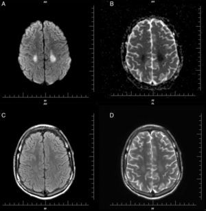 (A) Diffusion weighted imaging (DWI): symmetrical hyperintense signal in parietal lobe white matter, neither cortical area nor deep gray matter structures were affected. (B) Decreased apparent diffusion coefficient (ADC): symmetrical hyperintense signal. (C) Axial T2/FLAIR image: discreet symmetrical hyperintense signal in parietal lobe white matter. (D) Axial T2: discreet symmetrical hyperintense signal in parietal lobe. No abnormality was observed in T1.