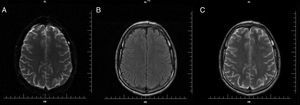Magnetic resonance imaging (MRI) of the brain 30 days after onset with no abnormal findings. (A) Diffusion weighted imaging (DWI). (B) Axial T2/FLAIR image. (C) Axial T2.