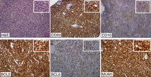 The tumor cells are positive for CD20, CD10, BCL2, BCL6 and MUM1. Original magnification images 200×.
