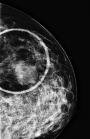 Left craniocaudal mammogram of the breast in a patient with primary breast lynphoma showing a round, dense mass.