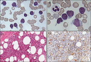 Neoplastic cell morphology in peripheral blood (A) and bone marrow aspirate films (B) showing small- to medium-sized lymphoplasmacytic lymphocytes (May Grunwald Giemsa stain, 1000×). Bone marrow biopsy (C) replaced by medium-sized lymphocytes (C1; Hematoxylin and eosin stain, 400×) and immunohistochemistry expression of Ki67 of tumor cells (C2; immunoperoxidase, 400×).