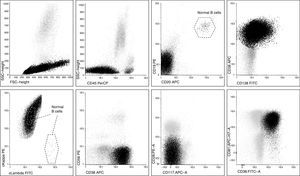 Flow cytometry dot plots of the circulating plasma cells (in black dots) showing small- to large-sized clonal plasma cells expressing (forward/side scatter of light) CD45−, CD19/CD20−, CD38++/CD138+ heterogeneous and ckappa+/lambda−. Neoplastic cells also expressed CD81 but were negative for CD56, CD28 and CD117. Normal B cells (in dashed lines) are CD45+, CD19/CD20+ and polyclonal (kappa+ and lambda+ populations).