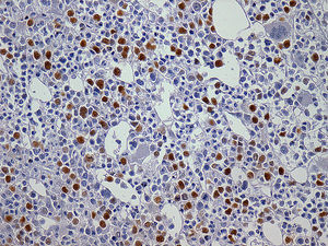 Bone marrow biopsy of patient with secondary myeloid neoplasm showing p53+ (immunohistochemical stains - 400×), previous disease: breast tumor.