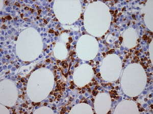 Bone marrow biopsy of patient with secondary myeloid neoplasm showing cluster CD34+ cells (immunohistochemical stains - 400×), previous disease: follicular lymphoma.