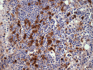 Bone marrow biopsy of patient with secondary myeloid neoplasm showing cluster CD117+ cells (immunohistochemical stains - 400×), previous disease: severe aplastic anemia.
