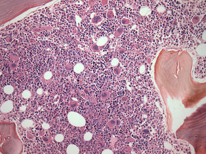 Bone marrow biopsy of patient with secondary myeloid neoplasm showing dysplasia and architectural changes in MGK serie (Hematoxylin and eosin stain - 200×), previous renal transplant.