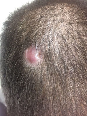 Isolated, 2.5cm×1cm raised skin lesion on the scalp vertex.