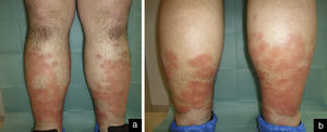 Anterior (a) and posterior (b) aspects of lower limbs at presentation. Confluent erythematous annular plaques circumferentially distributed on both legs and associated with bilateral edema.
