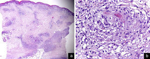 Histopathological findings. (a) Lymphohistiocytic infiltrate with a non-necrotizing granulomatous pattern involving the dermis and subcutaneous tissue (hematoxylin–eosin stain: original magnification ×20). (b) Detail of a cutaneous granuloma (hematoxylin–eosin stain: original magnification ×400).