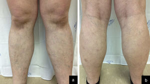 Anterior (a) and posterior (b) aspects of lower limbs after four cycles of chemotherapy. Regression of cutaneous lesions.