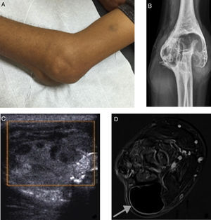 (A) Physical examination of the elbow demonstrating limited joint extension and deformity. (B) Radiography with notable bone deformity, in particular the distal humerus. (C) Ultrasonography demonstrating heterogeneous, ill defined, oval deformity with adjacent bone irregularity without vascularization according to a Doppler study. (D) Contrast T1 FAT SAT MRI with subtraction shows morphostructural deformity of elbow joint, with extensive deposition of low signal material in the synovium (hemosiderin) and extra-osseous hemophiliac pseudotumor measuring 4.9×3.5×3.6cm (gray arrow).