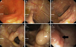 Endoscopic findings. (A) Small pseudopolypoid lesions on the duodenal bulb; (B–F) Multiple sessile polypoid lesions of different sizes throughout the colon; (F) Polypoid lesion with ulcerated surface.