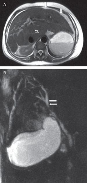 (A) Axial T2 weighted magnetic resonance imaging of the abdomen showing liver enlargement with increased left (LL) and caudate (CL) lobes, associated to slightly irregular contours (arrows). (B) Magnetic resonance cholangiopancreatography showing normal gallbladder and slight focal dilatation of the biliary tree (arrows) in the right hepatic lobe without biliary obstruction.