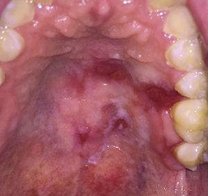 Generalized erythroleukoplakia with focal ulcerations affecting the hard and soft palate.