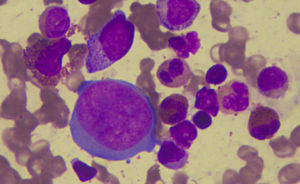 Bone marrow aspirate (magnification 400×: Leishman stain) giant proerythroblast with intranuclear inclusion and abundant cytoplasm and normal granulocytic precursors.