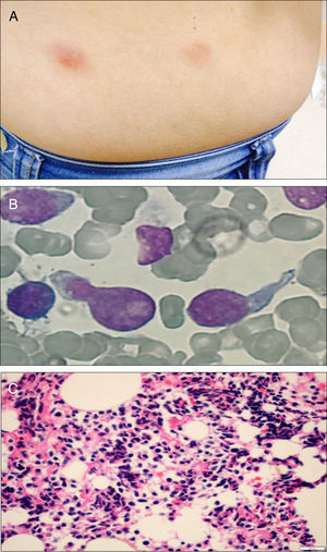 Physical and morphologic features of blastic plasmacytoid dendritic cell neoplasm. Cutaneous lesions on the patient's abdomen (A); morphology of leukemic blasts in the bone-marrow aspirate smear (B); anatomopathological study showing infiltration by blast cells (C).