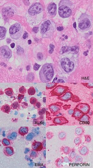 Peritoneal cell block showing atypical lymphoma cells with eccentric, horseshoe-nuclei (hematoxylin and eosin: 400×). ALKc, CD30, EMA and PERFORIN were detected by immunohistochemical staining in the Anaplastic Large Cell Lymphoma cells (400×).