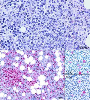 Histologic section from the bone marrow biopsy sample showing mild nodular and interstitial infiltration by small lymphocytes (Giemsa: 200×). CD3 highlights these lymphocytes (100×). CD30 and ALKc are detected by immunohistochemical staining in some of the atypical lymphocytes and become of essential importance to the differential diagnosis with T-cell prolymphocytic leukemia (400×).